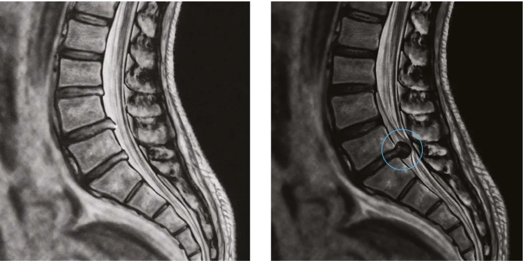 Exame de imagem mostrando o antes e o depois de uma cirurgia endoscópica para hérnia de disco