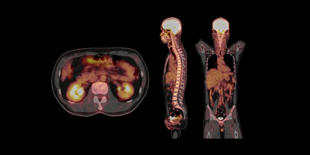 Exame PET Scan para diferenciar DIP de Parkinson no dia a dia