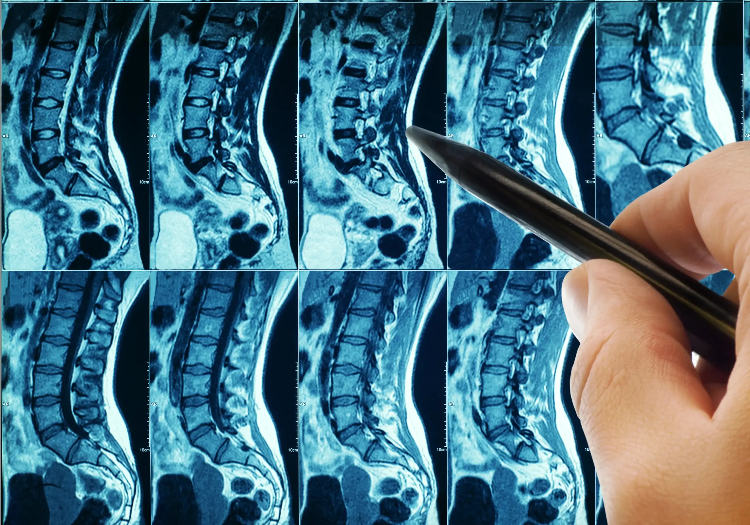 Uma mão segura uma caneta apontando para detalhes específicos em uma série de filmes de ressonância para dor lombar.