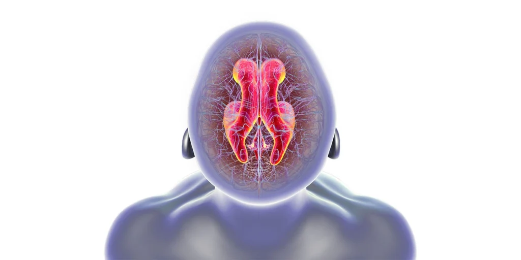 Visão superior de um cérebro com os ventrículos dilatados destacados em tons vibrantes, ilustrando o acúmulo de líquido na Hidrocefalia de Pressão Normal.