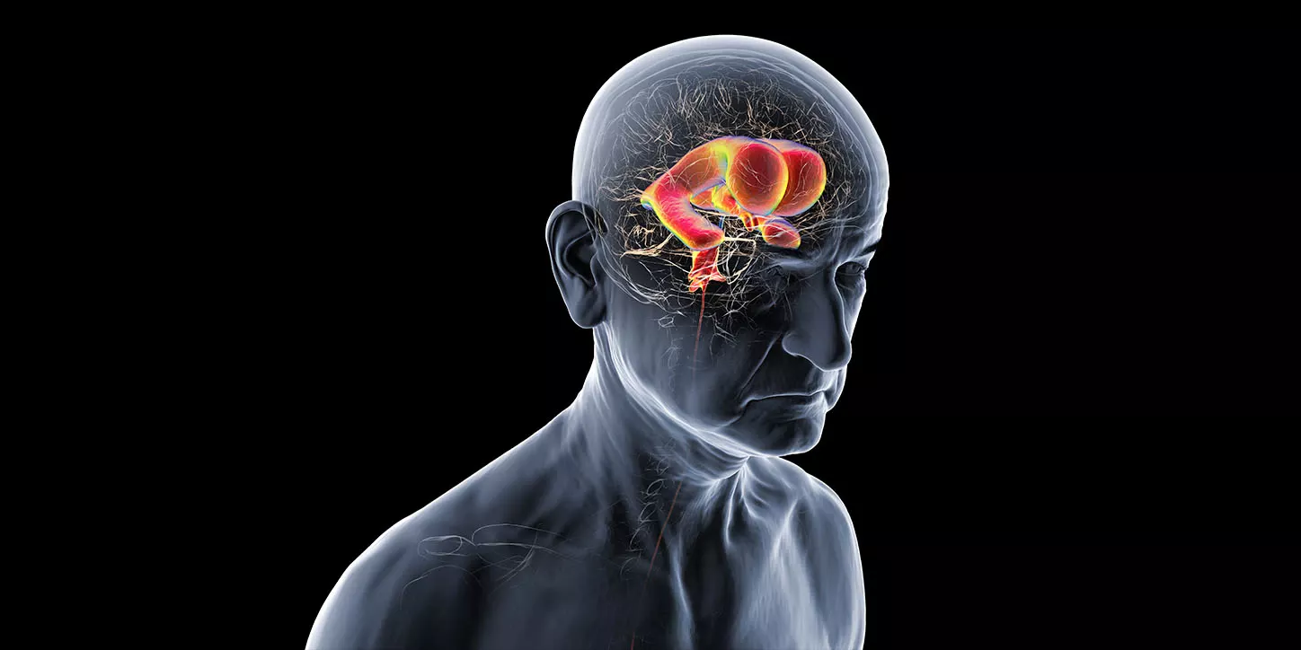 Ilustração médica da cabeça humana mostrando ventrículos cerebrais dilatados, característica central da Hidrocefalia de Pressão Normal.