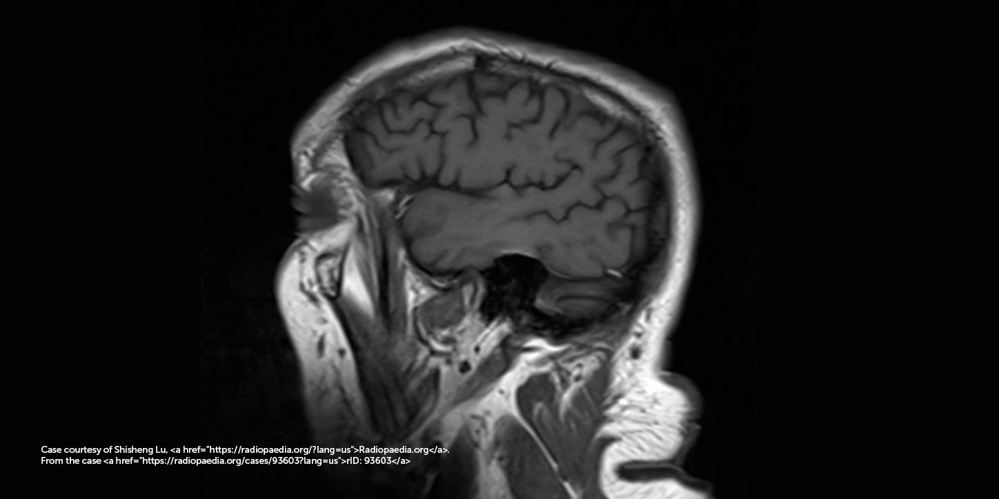 Mapeamento de atividade cerebral em múltiplos planos com escalas de cores, utilizado no diagnóstico diferencial de doenças neurodegenerativas como a Demência com Corpos de Lewy.