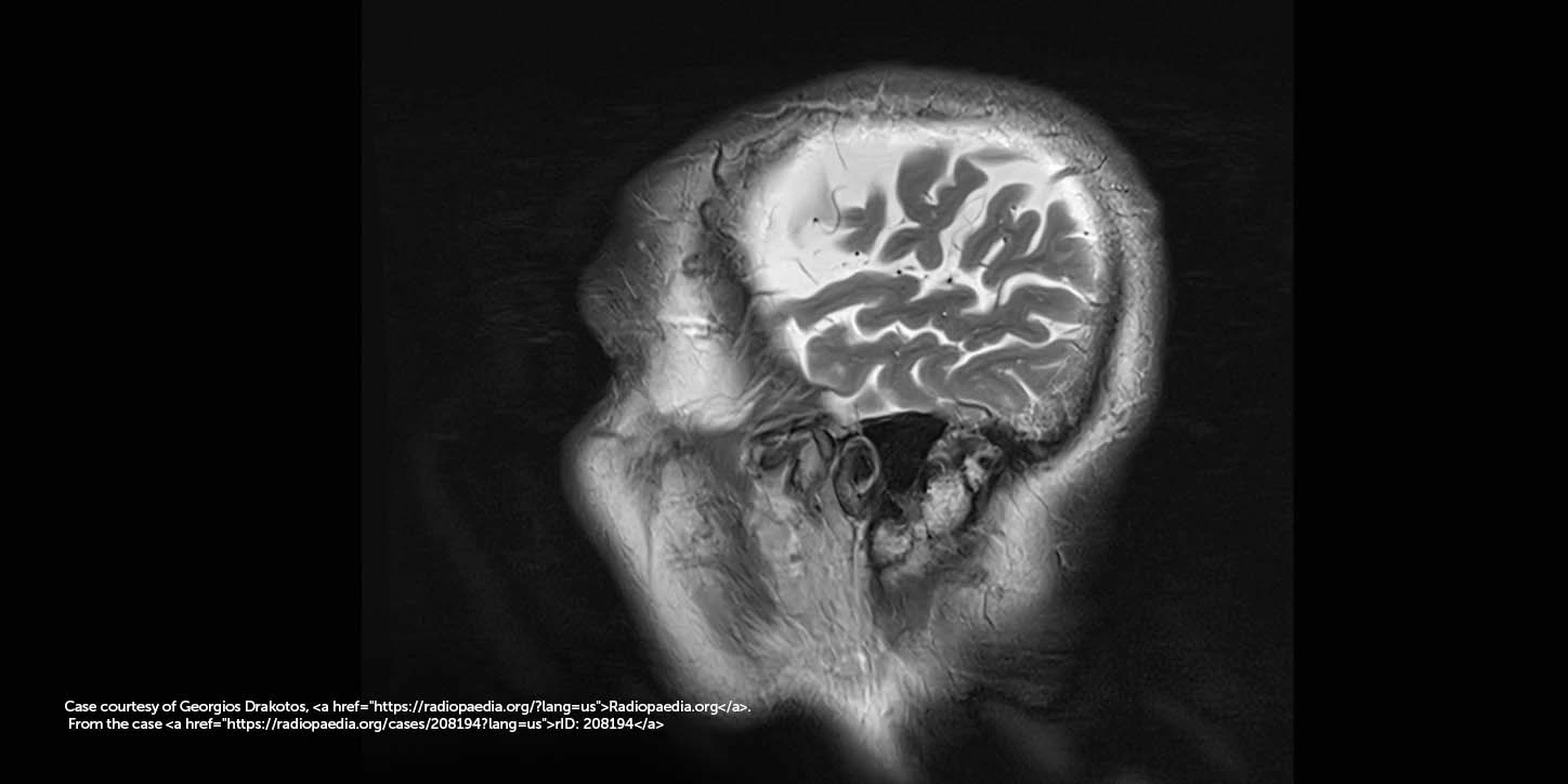Mapeamento colorido de PET scan cerebral em múltiplos planos para avaliar o metabolismo cerebral na investigação de Paralisia Supranuclear Progressiva.