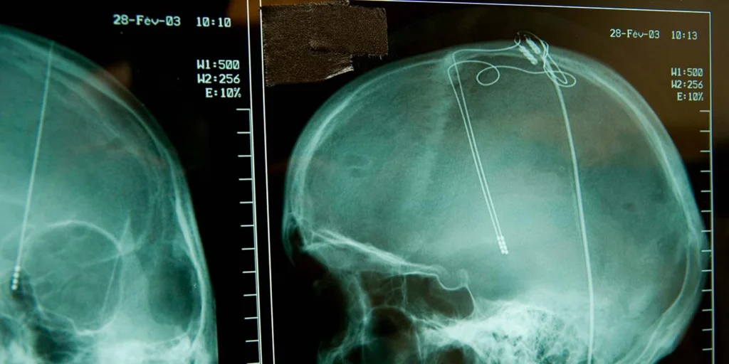 Radiografia de um crânio humano mostrando os eletrodos finos implantados, exemplificando o sistema de Estimulação Cerebral Profunda em Parkinsonismos Atípicos.