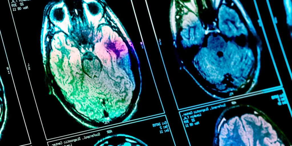 Cortes axiais de uma ressonância magnética do cérebro, exibindo áreas de atrofia cerebral que podem auxiliar no diagnóstico de Degeneração Corticobasal.