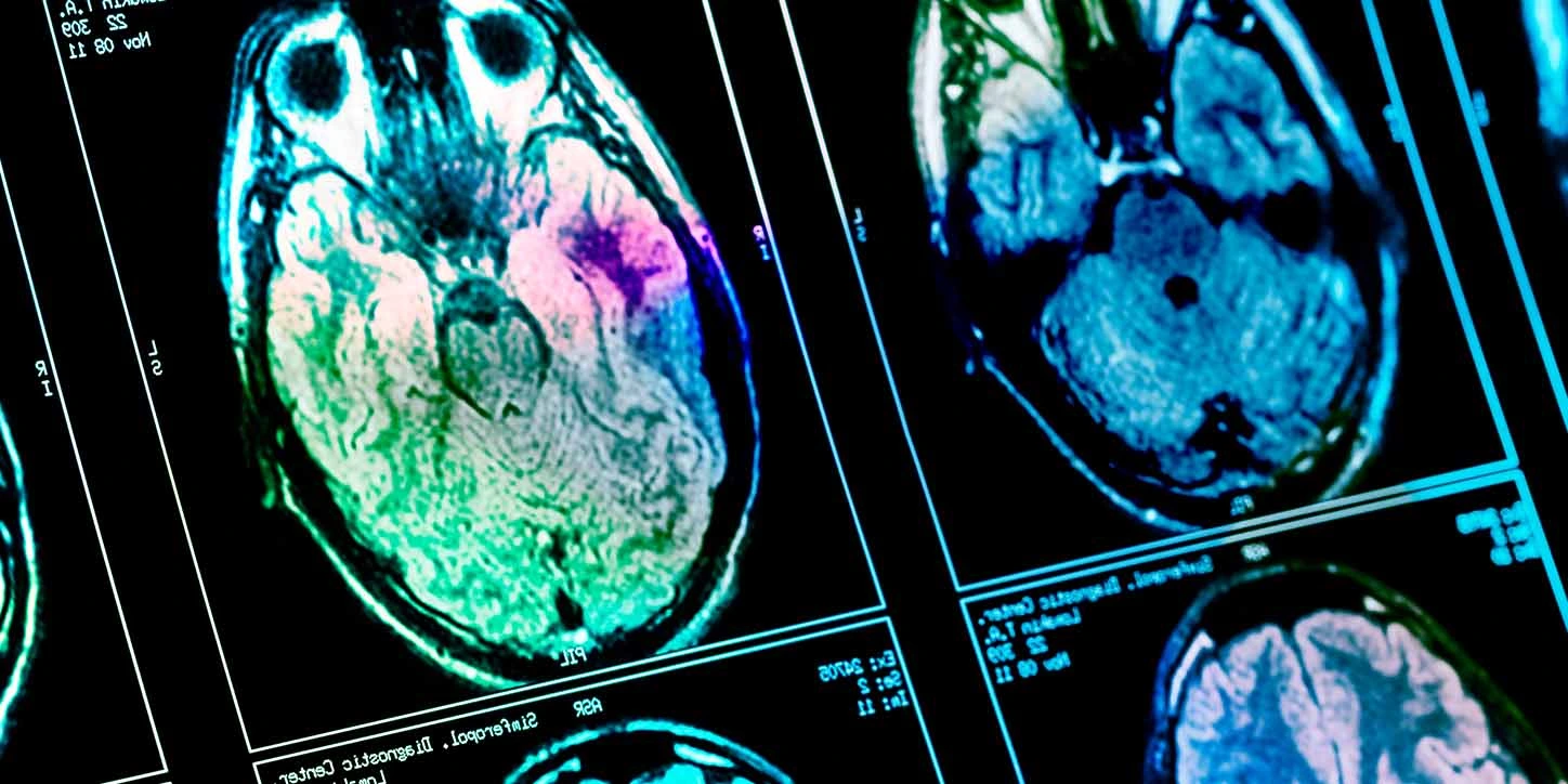 Cortes axiais de uma ressonância magnética do cérebro, exibindo áreas de atrofia cerebral que podem auxiliar no diagnóstico de Degeneração Corticobasal.