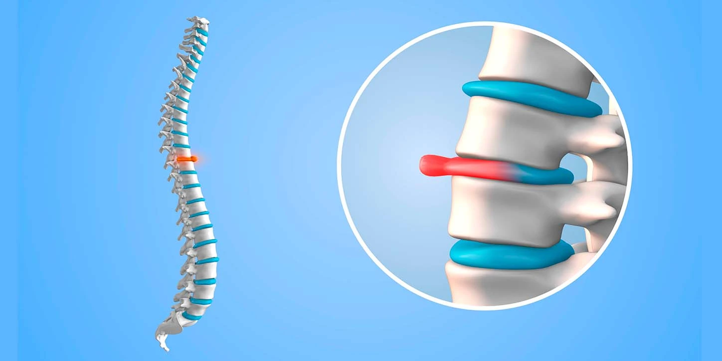 Um modelo anatômico da coluna vertebral com um círculo de aumento sobre um ponto vermelho, ilustrando uma extrusão discal lombar.